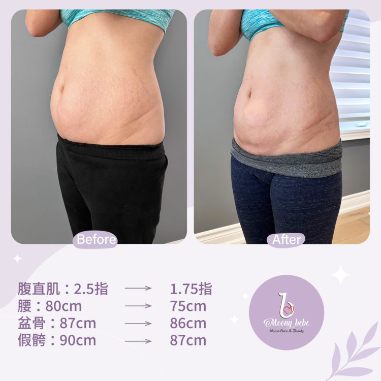Moonybebe多倫多紮肚效果側面對比圖
