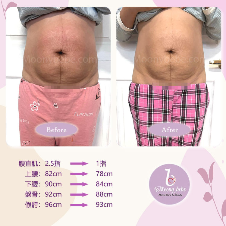 紮肚及盆骨修復 Before After | Moonybebe
