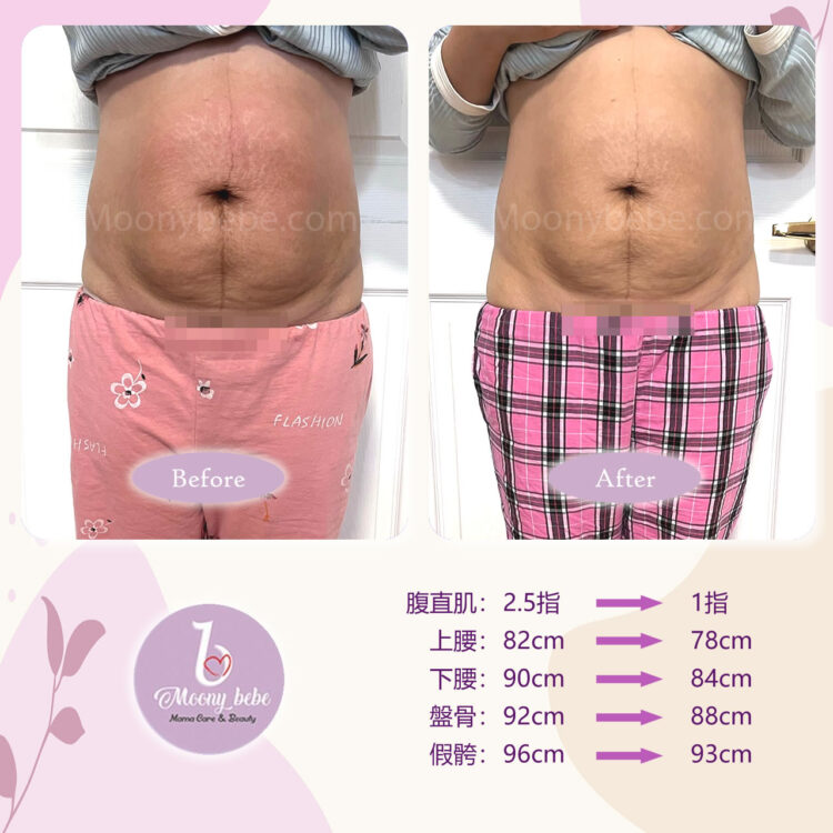 紮肚及盆骨修復 Before After | Moonybebe