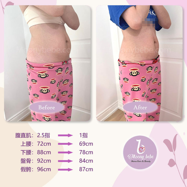 收復腹直肌分離 Before After 右側圖 | Moonybebe